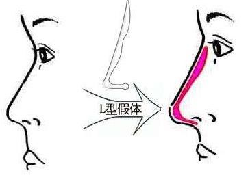 常见的隆鼻方式有哪些?一个鼻子漂亮的秘密(图2)