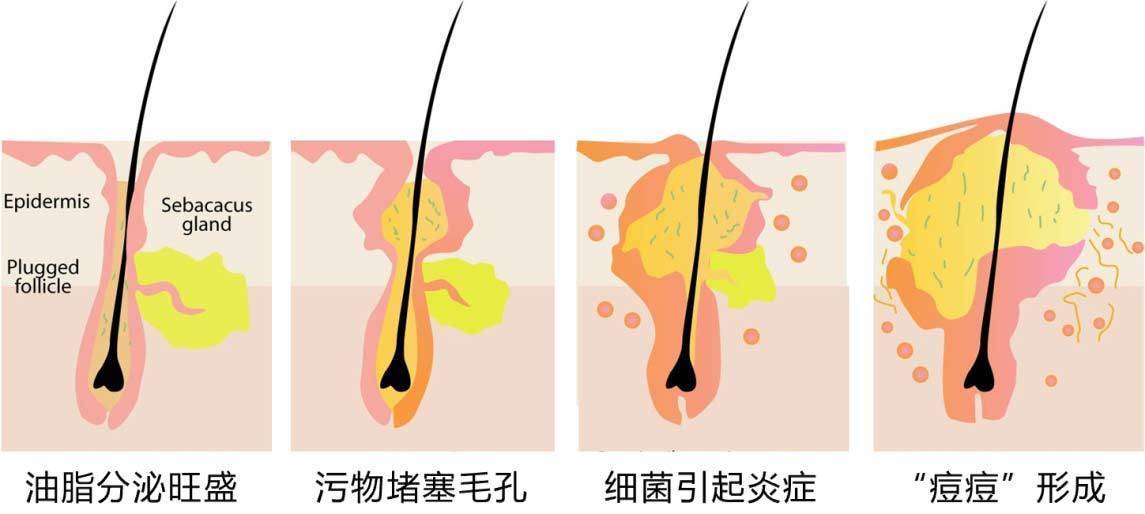 三十岁的女人换季痘肌能用美容油吗？(图1)
