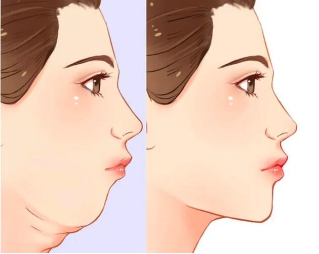 郑州美莱跟你聊聊双下巴吸脂术后保养很重要(图1)
